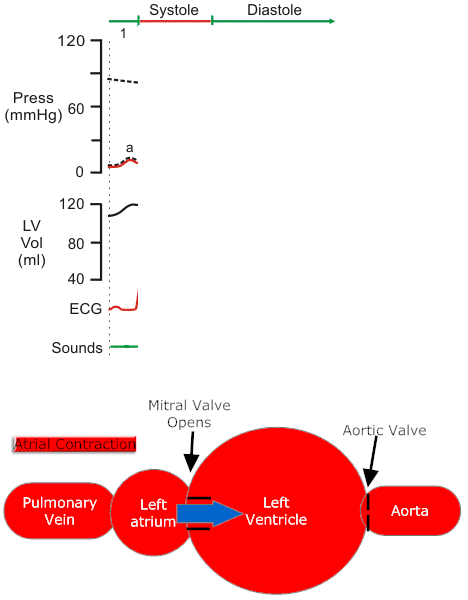 Mitral Regurgitation Animation